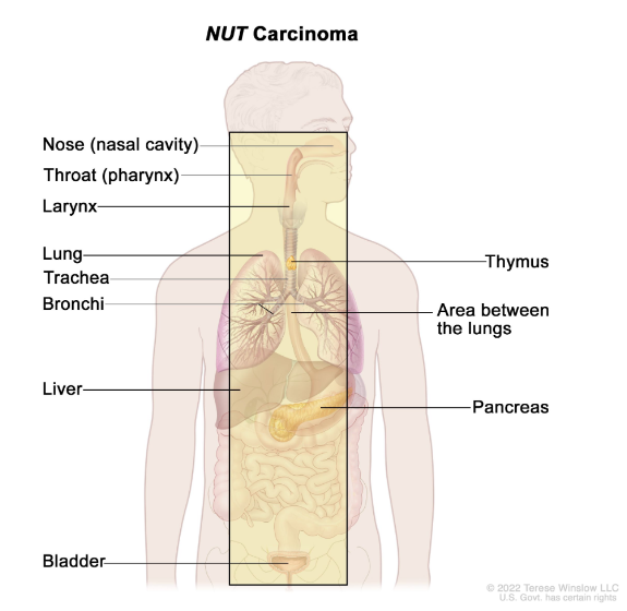 carcinoma.jpg