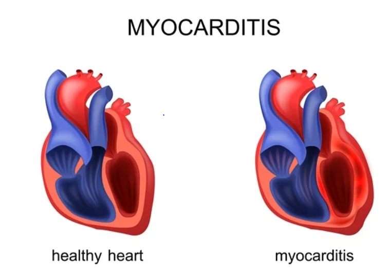 ΜΥΟΚΑΡΔΙΤΙΔΑ