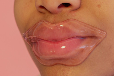 Αποτυχημένο υαλουρονικό στα χείλη: Υπάρχει γυρισμός;
