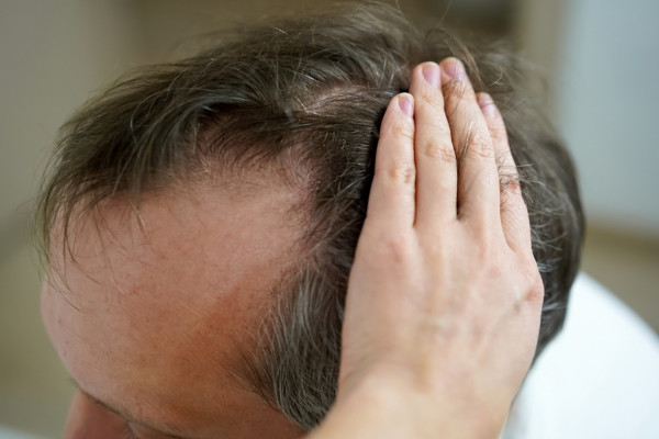 Τριχόπτωση: Οι λόγοι που «πέφτουν» τα μαλλιά σας