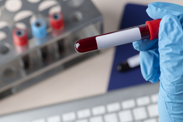 Καρκίνος τραχήλου- κεφαλής από τον ιό HPV: Απλή εξέταση αίματος τον εντοπίζει 10 χρόνια πριν τα συμπτώματα