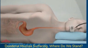 Ελάχιστα επεμβατική μέθοδος υπόσχεται διατήρηση της απώλειας κιλών και μετά τη διακοπή των GLP-1