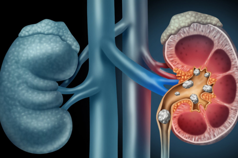 Πέτρες στα νεφρά και σύγχρονη αντιμετώπιση