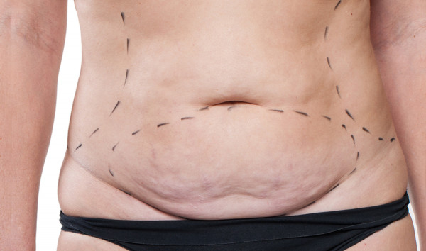 Απώλεια βάρους: Έτσι μπορείς να απαλλαγείς αποτελεσματικά από την υπερβολική χαλάρωση