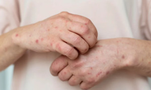 Αναφυλαξία και αλλεργικό σοκ: Πότε μια αλλεργία γίνεται απειλητική για την ζωή