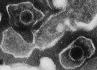 Νέα μελέτη δείχνει ότι ο ιός Επστάιν-Μπαρ κρύβεται πίσω από την πολλαπλή σκλήρυνση