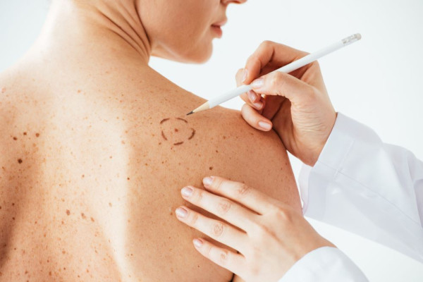 Ποιοι ιοί ευθύνονται για καρκίνο του δέρματος - Οι τρόποι προφύλαξης που υπάρχουν