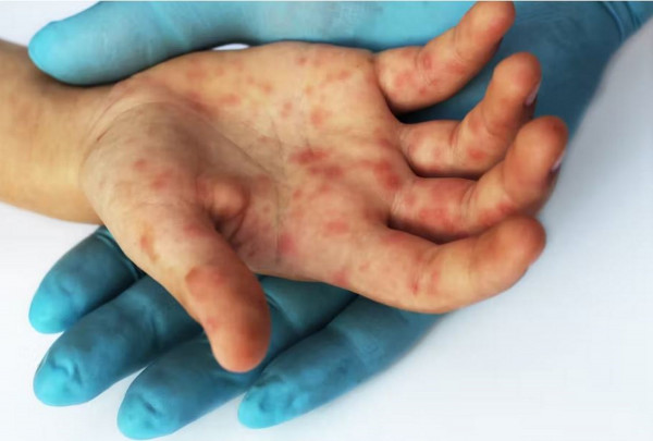 ΠΟΥ και Unicef προειδοποιούν ότι αναμένεται σημαντική αύξηση κρουσμάτων ιλαράς παγκοσμίως