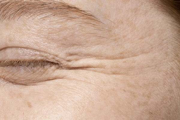 Ερευνητές κατάφεραν να αναστρέψουν μια διαδικασία γήρανσης στην επιδερμίδα