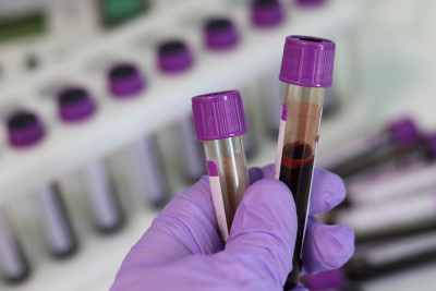 Νέα εξέταση αίματος προβλέπει την ανταπόκριση ασθενών με καρκίνο του πνεύμονα στην ανοσοθεραπεία