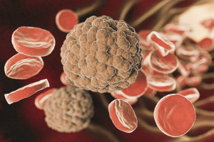 Νέο αντιθρομβωτικό φάρμακο μειώνει τον κίνδυνο νέου εγκεφαλικού επεισοδίου