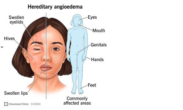 Σπάνια νοσήματα: Η Ευρώπη εγκρίνει καινοτόμο θεραπεία για την πρόληψη του κληρονομικού αγγειοοιδήματο