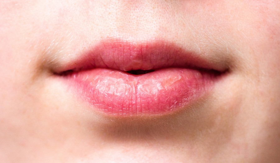 Δερματολόγος δίνει tips για να αποφεύγουμε τα σκασμένα χείλη