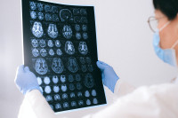 Μηνιγγίωμα εγκεφάλου: Τι είναι και πώς αντιμετωπίζεται