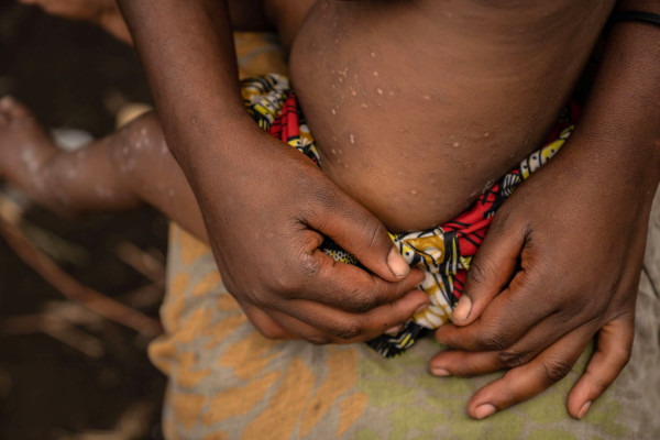 ΠΟΥ: Ανάγκη άμεσου περιορισμού των κρουσμάτων ευλογιάς των πιθήκων - Χαμηλός ο δείκτης θνητότητας