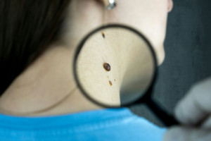 Τύπος του ιού HPV ευθύνεται για την ανάπτυξη καρκίνου του δέρματος