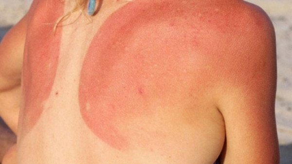 Ηλιακό έγκαυμα: 9 οδηγίες αντιμετώπισης για την ανακούφιση του δέρματος