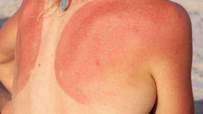 Ηλιακό έγκαυμα: 9 οδηγίες αντιμετώπισης για την ανακούφιση του δέρματος