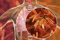 Προειδοποίηση ΠΟΥ: Η φυματίωση επιστρέφει σε όλο τον κόσμο