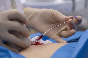 Καθετήρες και βηματοδότες μπορούν να γίνουν το τέλειο περιβάλλον για θανατηφόρους μύκητες