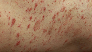 Τι είναι το εξάνθημα Disney και πότε κινδυνεύετε να το εκδηλώσετε