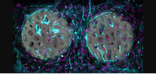 Εμφύτευμα υδρογέλης προϊόν εκτύπωσης λέιζερ μπορεί να φέρει επανάσταση στην αποκατάσταση των οστών