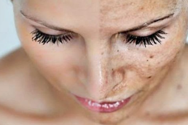 Μέλασμα: Πώς να προστατεύσετε το δέρμα σας από τις πανάδες