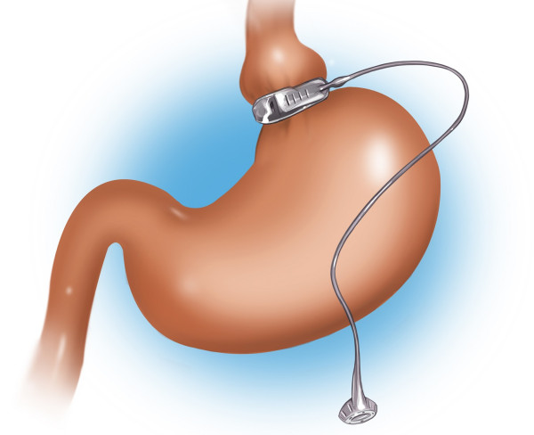 Γαστρικός Δακτύλιος: Πότε και γιατί πρέπει να αφαιρείται;