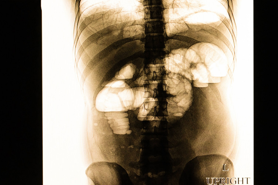 Ακτινογραφία ασθενούς με ειλεό IMAGO / YAY Images