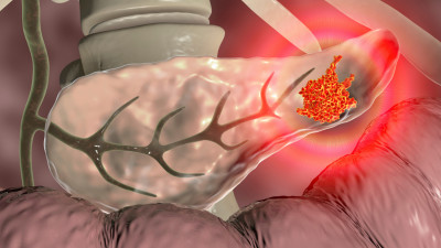 Φως στη διαδικασία σχηματισμού των όγκων: O τραυματισμός στο πάγκρεας μπορεί να οδηγήσει σε καρκίνο