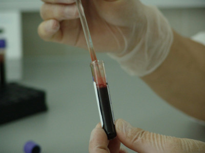 Covid -19: Αυξημένος κίνδυνος για λοίμωξη σε ασθενείς με καρκίνο ακόμα και αν είναι εμβολιασμένοι διπλά