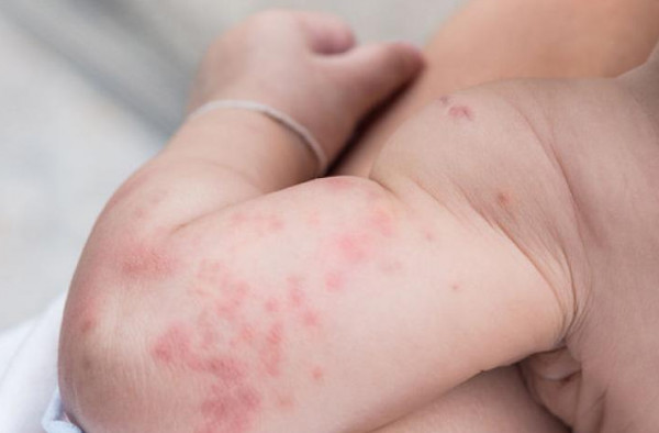 Τουλάχιστον 117 εκατομμύρια παιδιά κινδυνεύουν να μην εμβολιαστούν ενάντια της ιλαράς