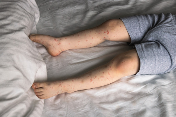 Η ιλαρά ξαναέγινε ενδημική σε έξι ευρωπαϊκές χώρες - Ο ρόλος του δισταγμού έναντι του εμβολιασμού