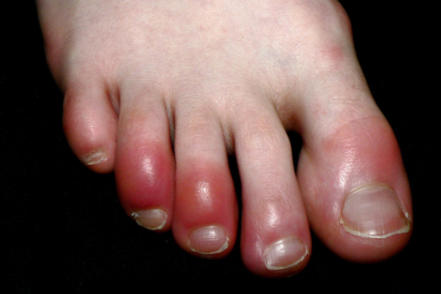 Ο κορονοϊός προκαλεί δερματικά συμπτώματα - Τι είναι τα «δάχτυλα COVID-19»