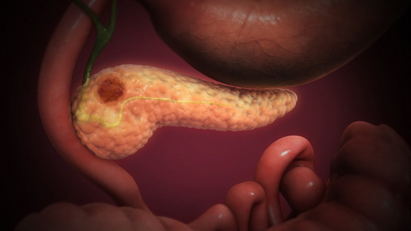 &quot;Pancreatic Cancer&quot; by Scientific Animations Inc.