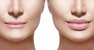 Lip Lift: Η αναίμακτη μικροεπέμβαση που αναβαθμίζει το πρόσωπο