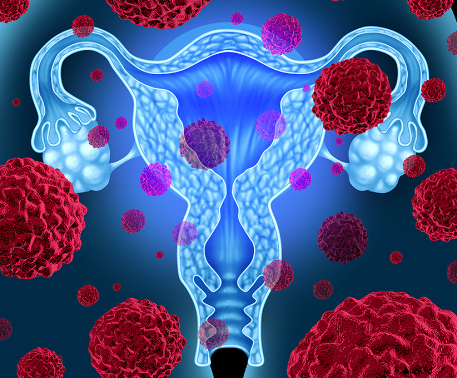 Καρκίνος ενδομητρίου: Νέα δεδομένα για την θεραπεία