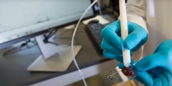 Χειρουργική συσκευή εντοπίζει τον καρκίνο σε 90 δευτερόλεπτα