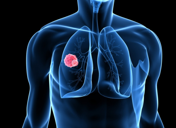 Νέα θεραπεία δίνει σημαντικές ελπίδες για τον καρκίνο του πνεύμονα