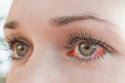 Τι προκαλεί στα μάτια η ευλογιά των πιθήκων και τι μπορούν να κάνουν οι ασθενείς
